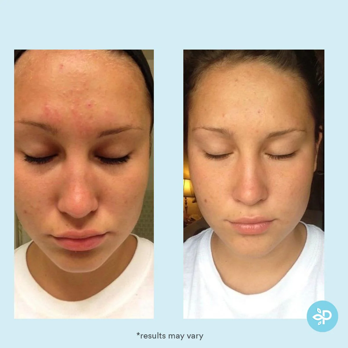 Glycolic 30% Gel Peel - Image 5