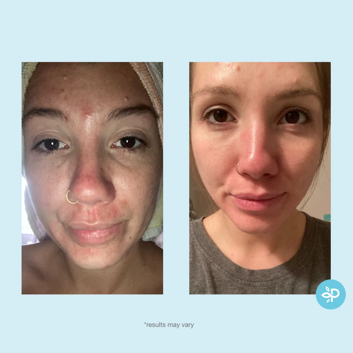 Glycolic 30% Gel Peel - Image 7