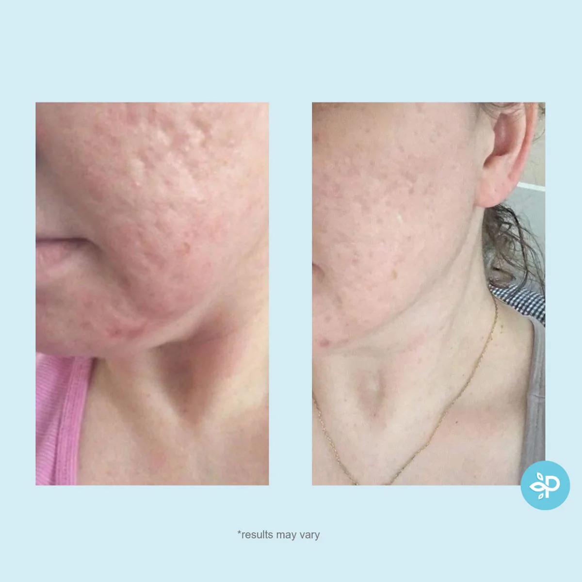 Glycolic 50% Gel Peel - Image 6
