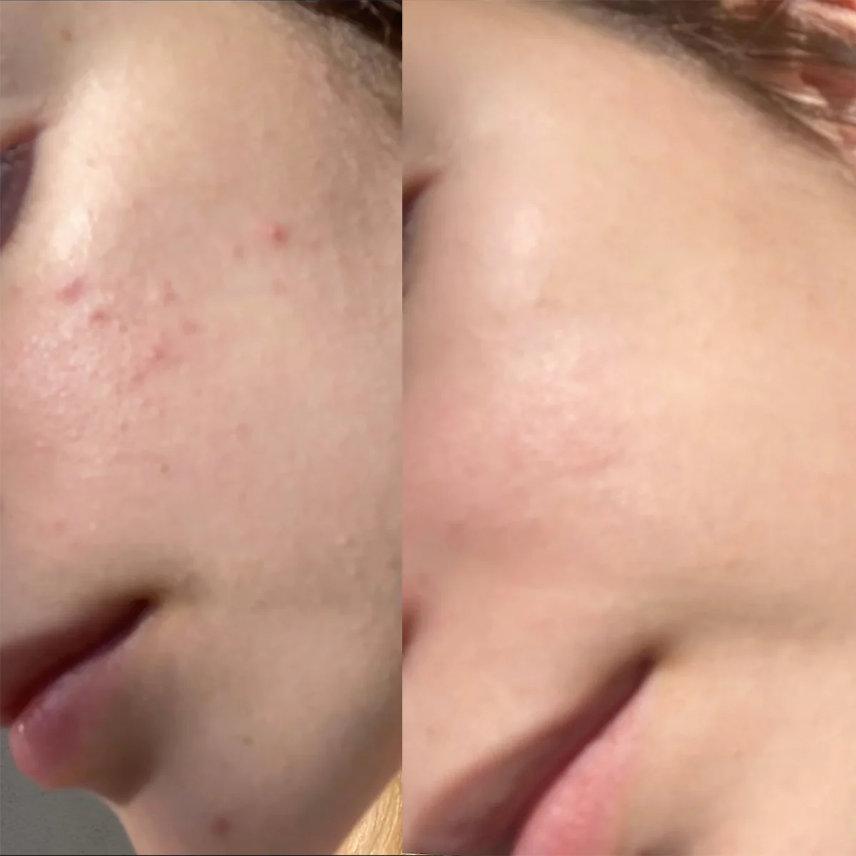 Lactic 10% Gel Peel - Image 4