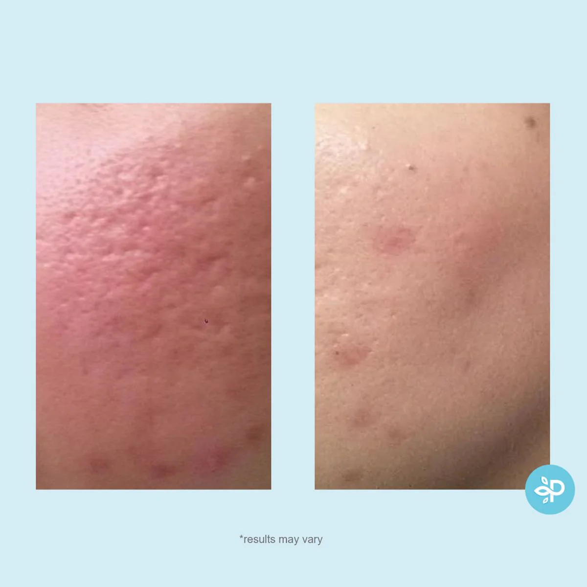 Lactic 50% Gel Peel - Image 4