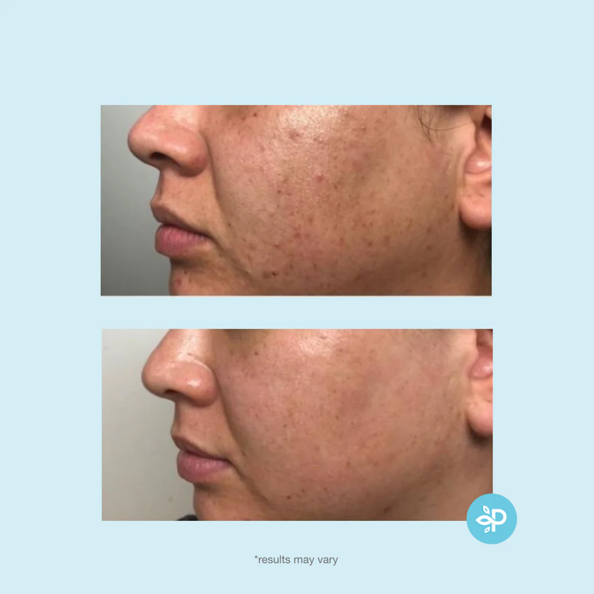 Revitaboost Peel Pads 35% - Image 9