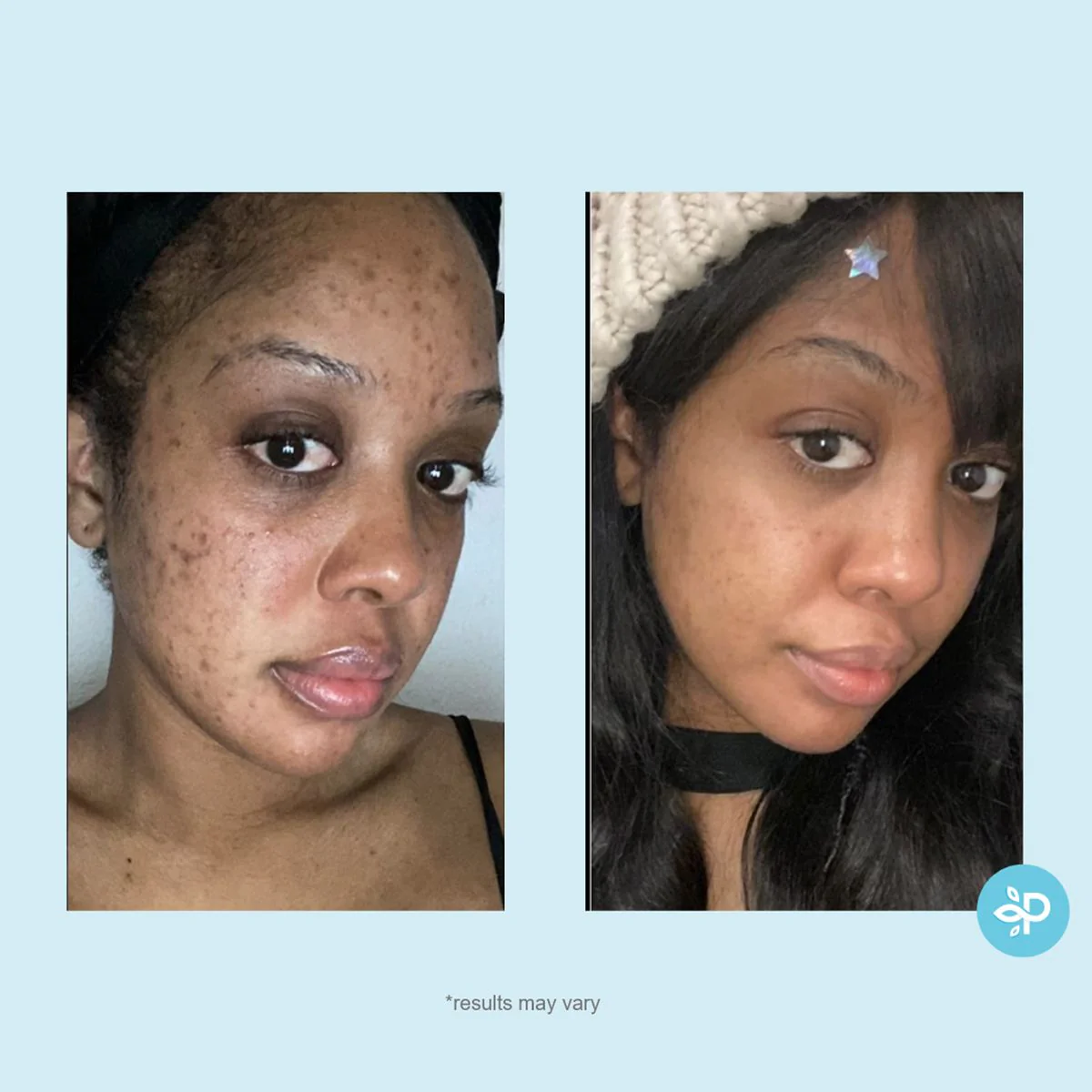 Salicylic 10% Gel Peel - Image 5