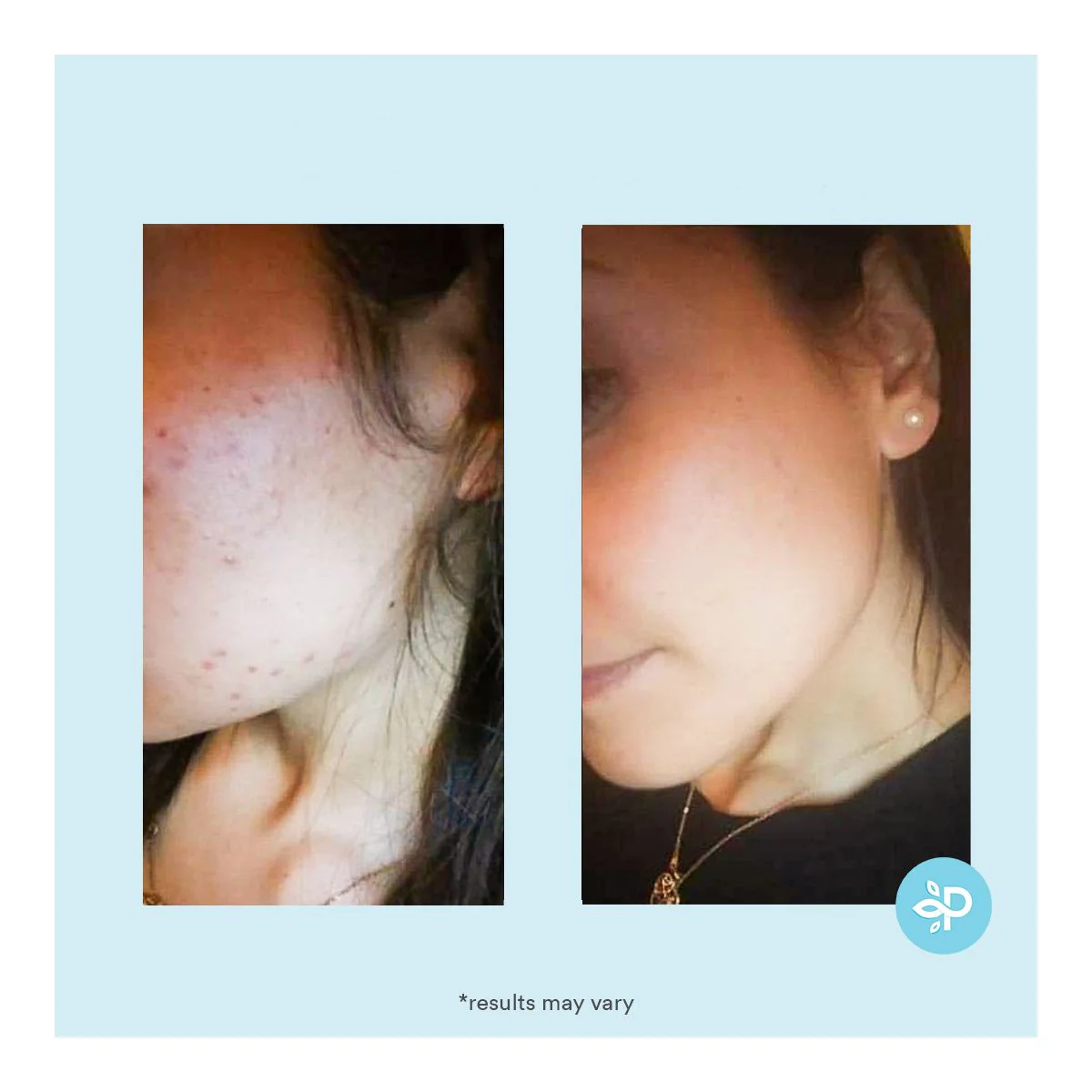 Salicylic 20% Gel Peel - Image 6