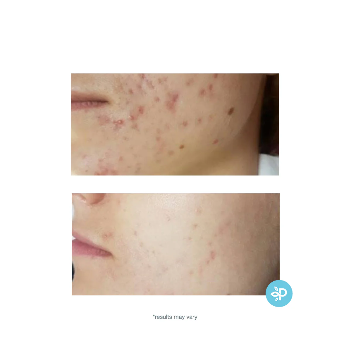 TCA 15% Skin Peel - Image 9