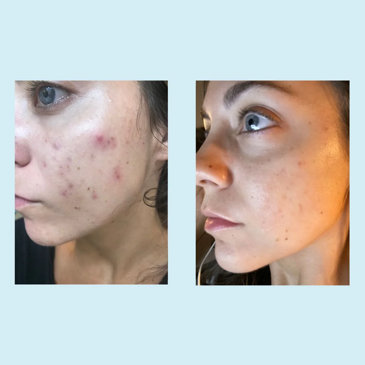 Tri-Clarity Peel Pads 25% - Image 5